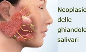 Illustrazione di un tumore della ghiandola salivare operabile dal Dott. Porro