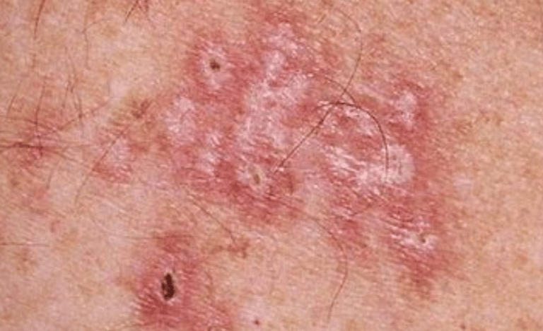 herpes genitalia