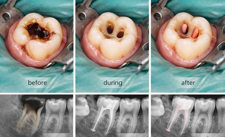 multi root treatment 