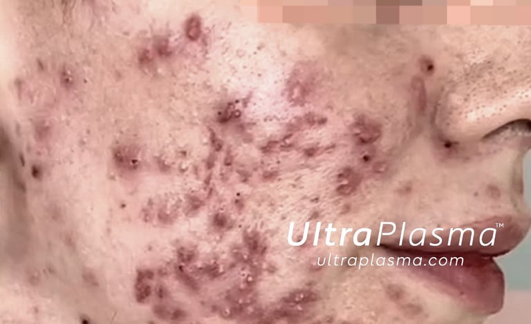 akne_acne_ultra_plasma_ultra_plazma_ultra-plasma_ultra-plazma