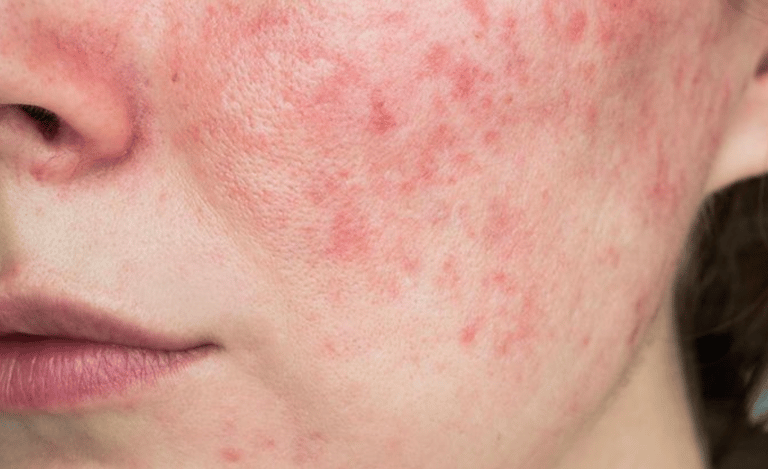 Da bị burn-out do lạm dụng treatment