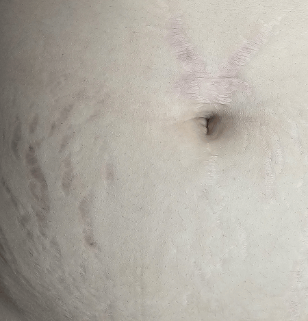 Stretch marks before treatment in a young woman following pregnancy