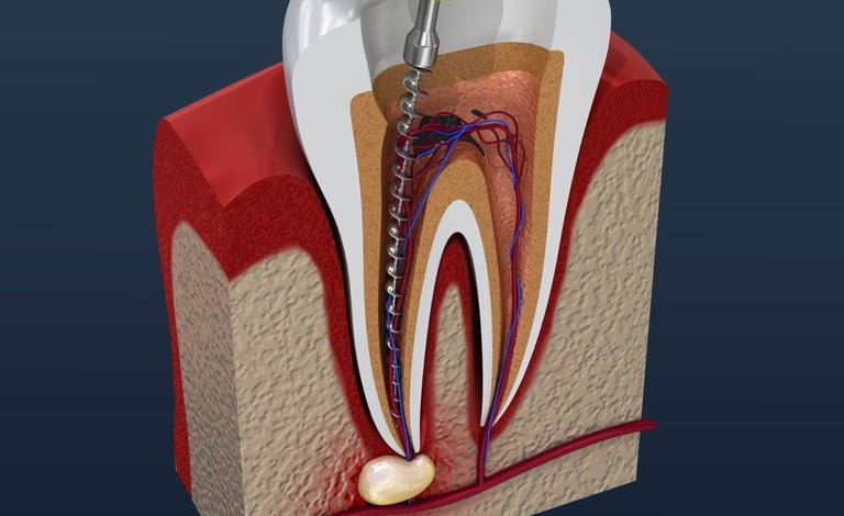 A photo of Root Canal Treatment