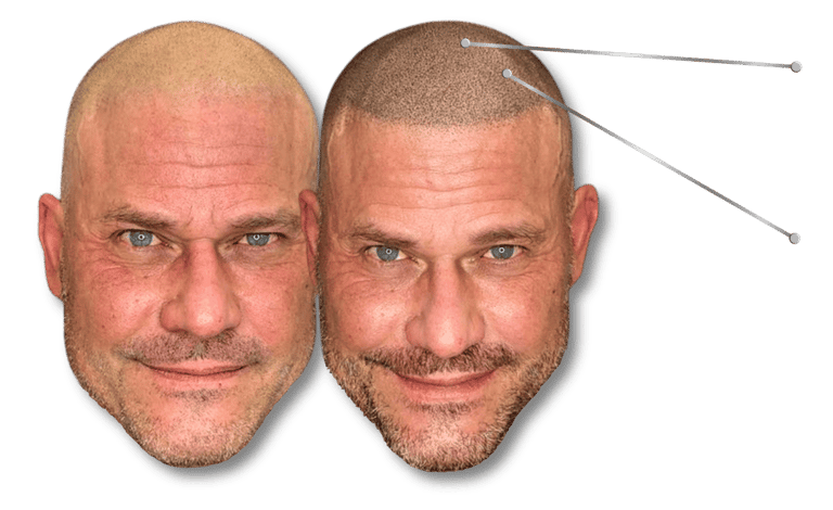 Before and after Scalp Micropigmentation treatment showing realistic hair follicle simulation for a shaved head look.