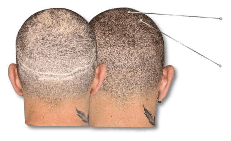 Before and after scalp micropigmentation showing effective hair transplant scar camouflage.