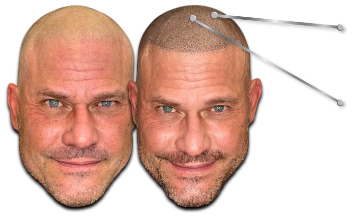 Before and after comparison of scalp micropigmentation for male hair loss restoration.