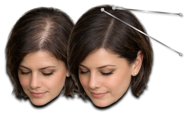 Before and after comparison of a woman's thinning hair showing successful hair regrowth treatment results.