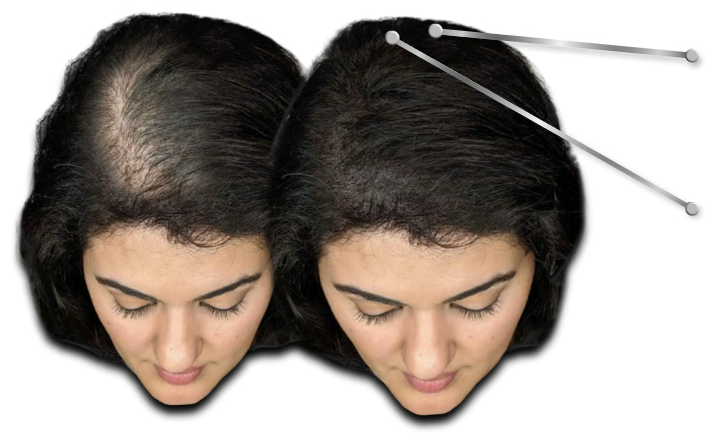 Before and after comparison of a woman's scalp showing effective hair loss treatment and regrowth.