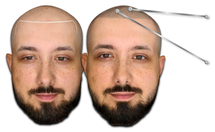 Before and after scalp micropigmentation showing a bald head restored with a natural hairline tattoo.