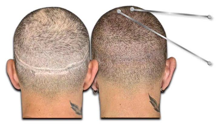 Before and after scalp micropigmentation to camouflage an FUT hair transplant scar on the back of the head.