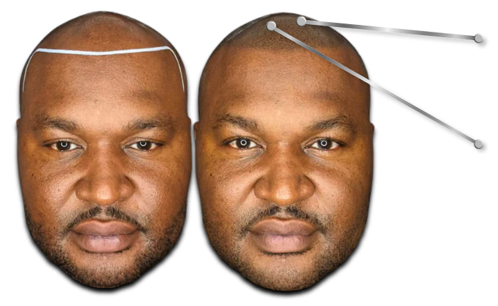 Before and after scalp micropigmentation showing a restored hairline for male pattern baldness.