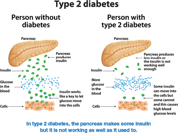 Type 2 diabetes