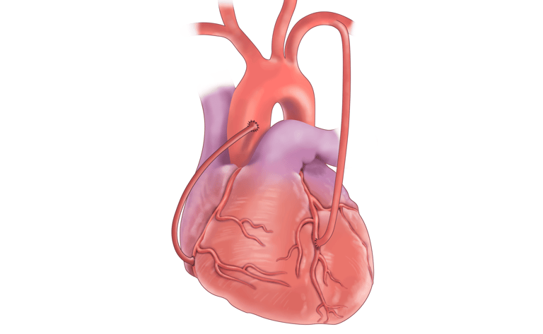 vascular ultrasound coronary artery bypass graft mapping radial surgery heart arm scan imaging perth blocked cabg chest pain