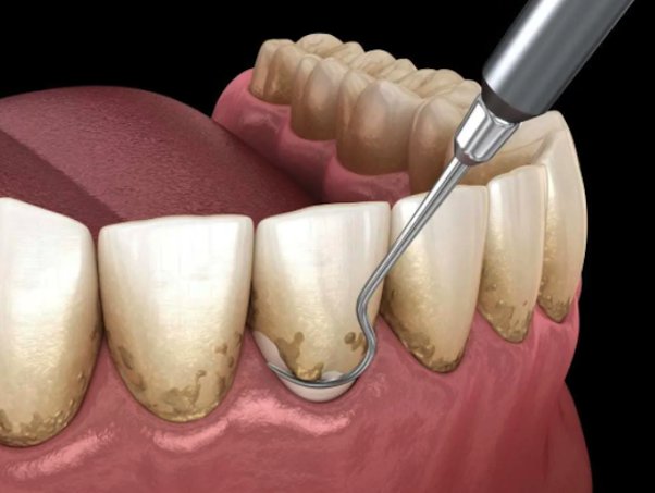 a image showing scaler used to scaling in anterior 