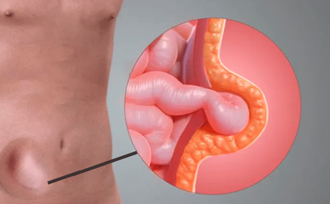 Imagem ilustrativa de Hérnia Incisional