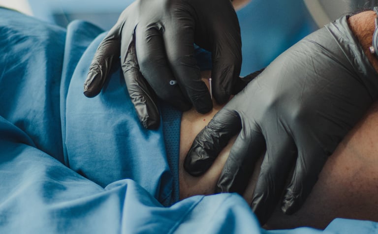 Acupuncture and Dry Needling for Pain Relief at Home