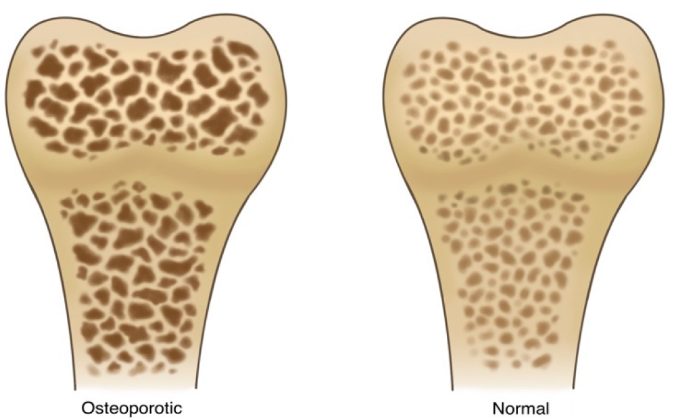 a comparison of a bone bone bone bone bone bone bone bone bone bone bone bone