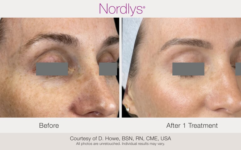 before and after skin texture improvement treatment results in Hamilton clinic