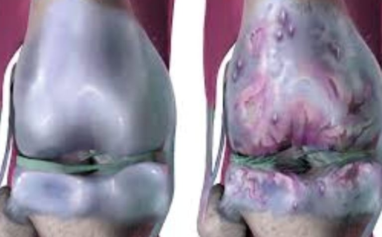 regeneration of cartilage