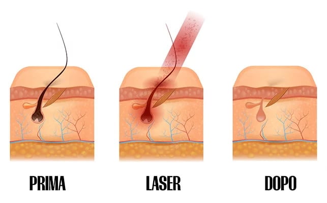 Fasi del trattamento di epilazione laser al diodo prima durante e dopo in centro