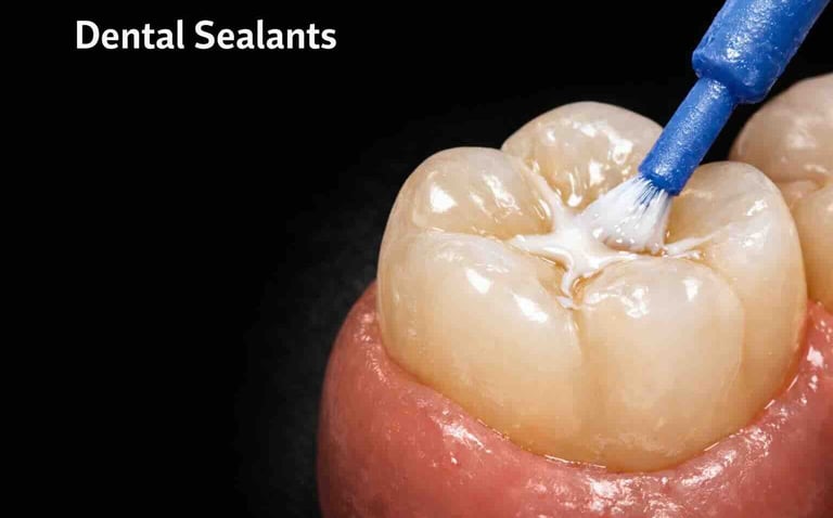 dental sealants