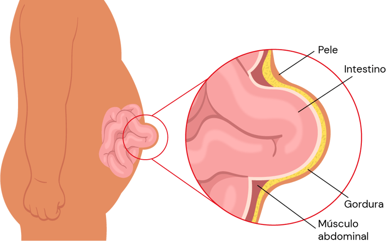Hérnia no umbigo. Dor na barriga. 