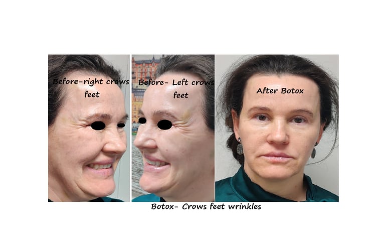 Före- och efterbilder av botox runt ögonen – slätare hud och yngre utseende.
