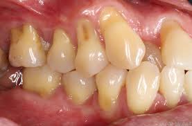 a image showing receeding gums