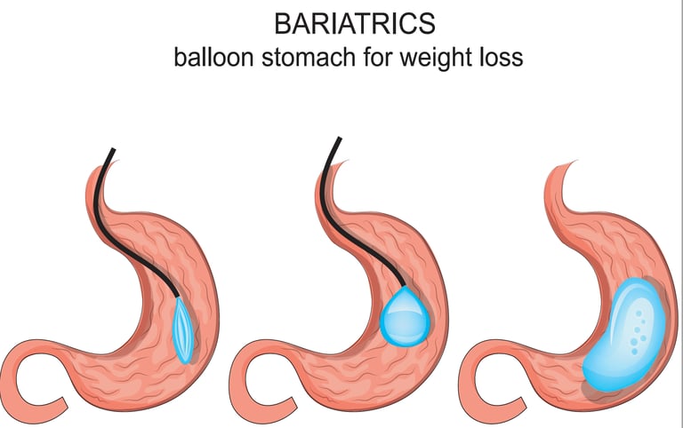 illustration of gastric ballon