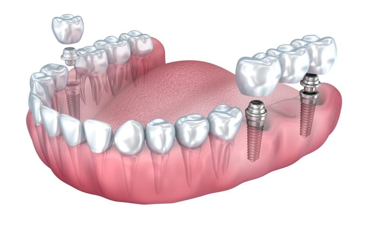 a image showing dental implants with crown being placed