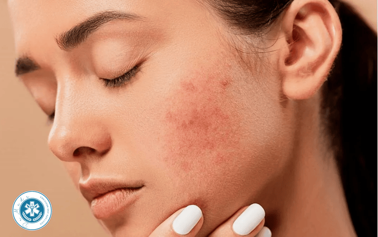 Pimple Acne