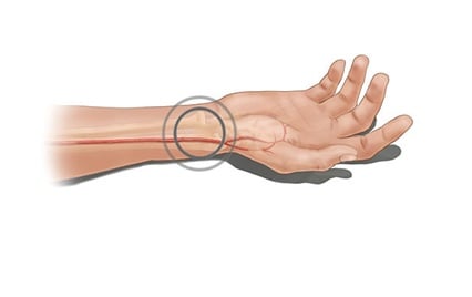 vascular ultrasound coronary artery bypass graft mapping radial surgery heart arm scan imaging perth blocked cabg chest pain