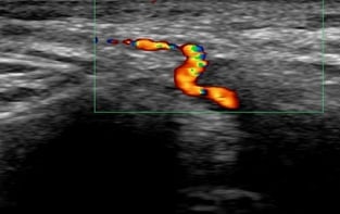 vascular ultrasound artery temporal facial parietal giant cell arteritis pain face vision jaw symptoms polymyalgia rheumatica