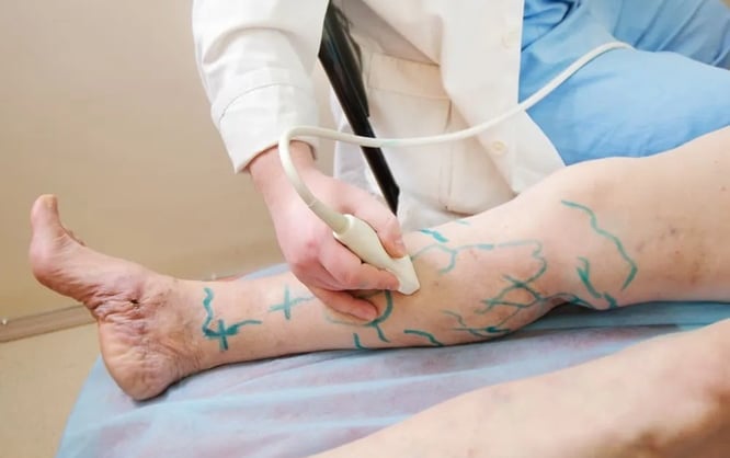 vascular ultrasound venous skin marking varicose veins surgery pre operative mapping vein skin imaging leg swelling treatment