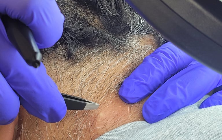 Permanent hair removal Electrolysis Edmonton