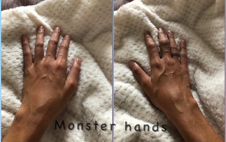 rheumatoid arthiritis hands