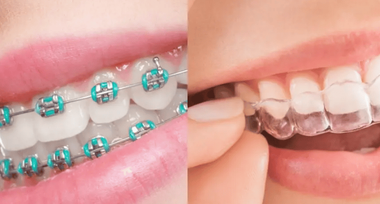 الفرق بين التقويم العادي والشفاف