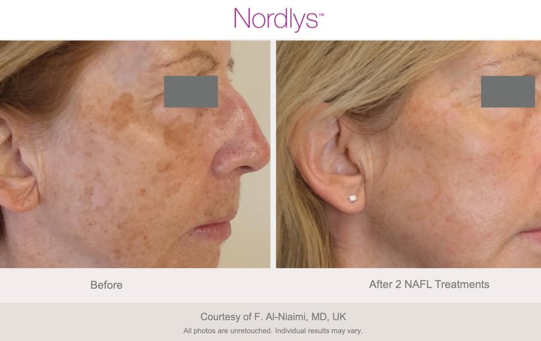 advanced pigmentation removal treatment for clearer skin in Hamilton Ontario