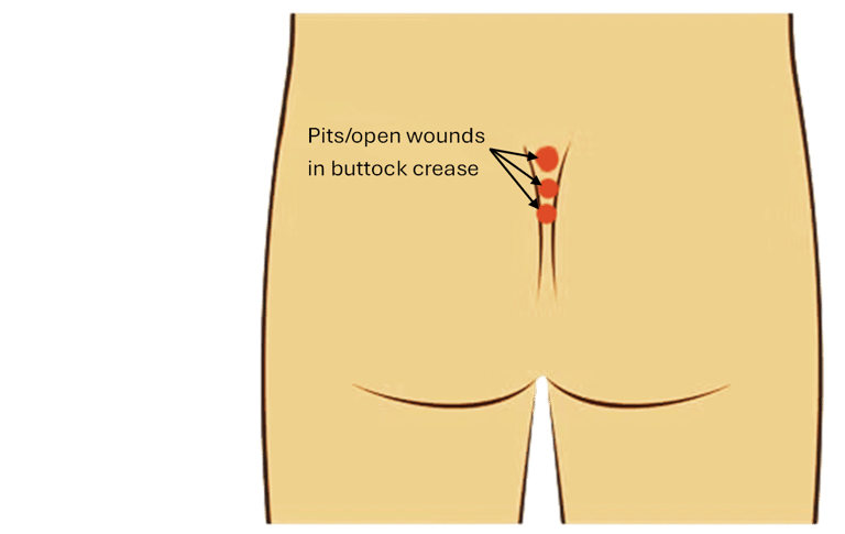 Diagram showing pilonidal cyst pits and open wounds located in the buttock crease.