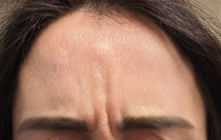 Inspire Salon and Day Spa client before Botox Treatment
