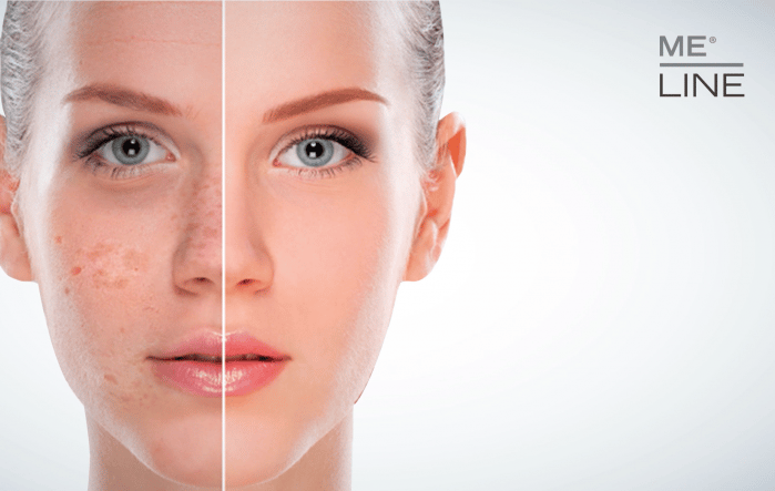 Vrouw waarbij 2 verschillende pigmentsoorten worden getoond op haar gezicht