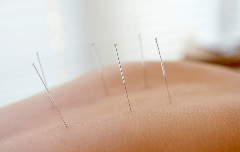 Acupuncture needles up close whilst being used for back pain.