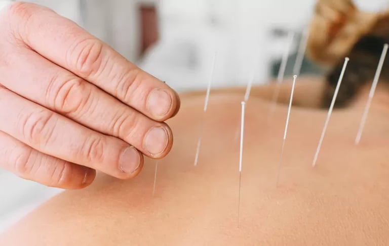 Acupuncture Montauban