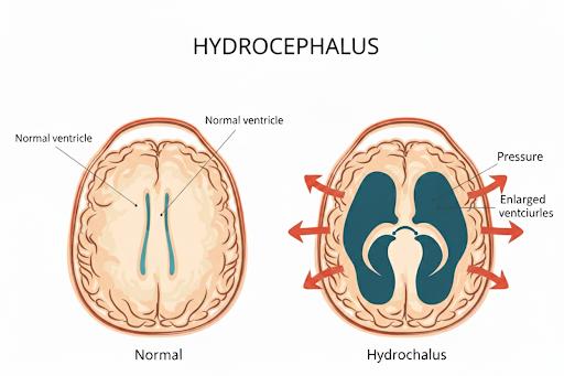 Figura esquemática da hidrocefalia. Site de Fortaleza