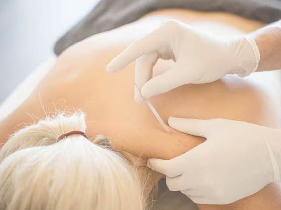 Dry needling being performed