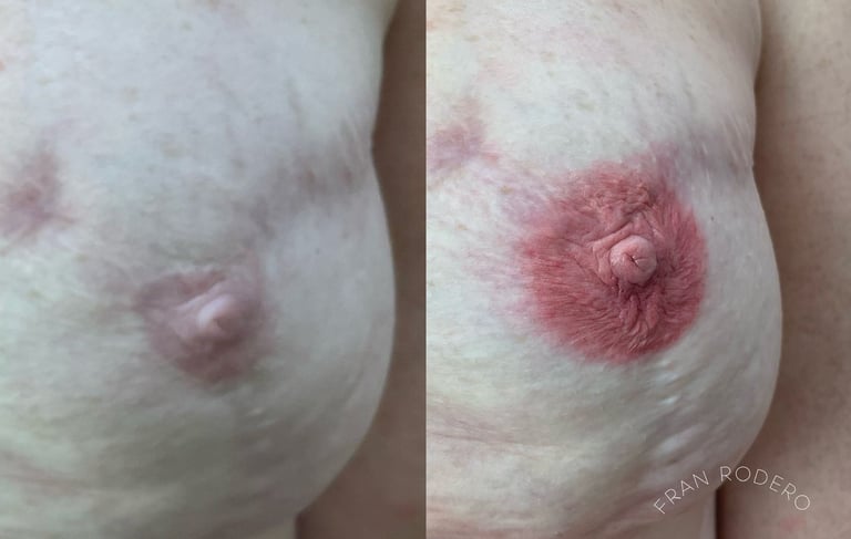 reconstrução de aréolas realistas após cirurgia de mastectomia