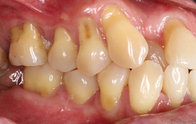 a image showing receding gums