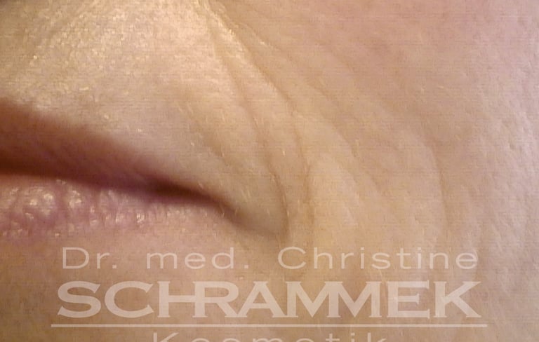 a woman before green peel energy from dr schrammek