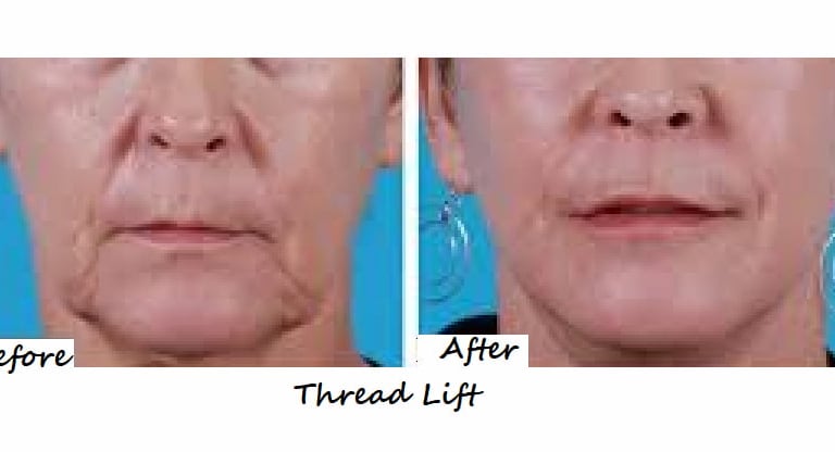 Before and after thread lift in mid and lower face with skin tightening.