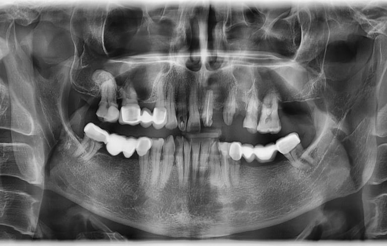 Rezectie apicala + chistectomie